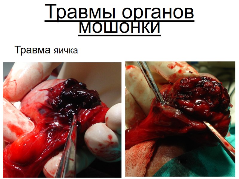 Травмы органов мошонки Травма яичка